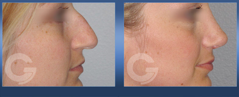 Before and After Result